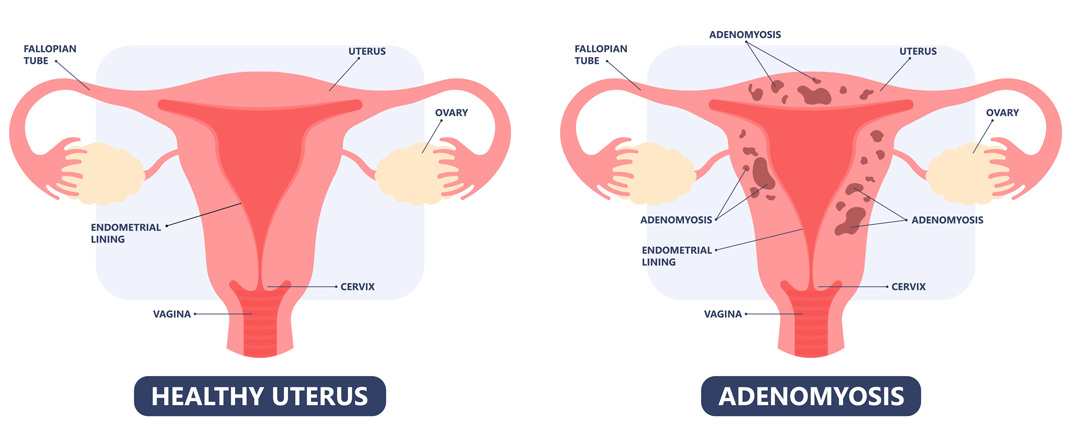 normal uterus and Adenomyoma