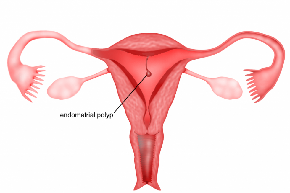 endometrial polyp removal icd 10 code