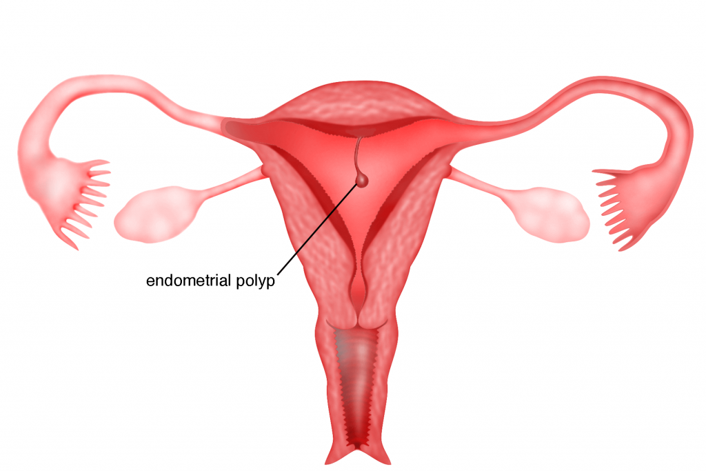 Endometrial Polyp Removal