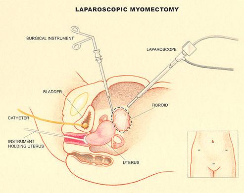 Laparoscopic Myomectomy