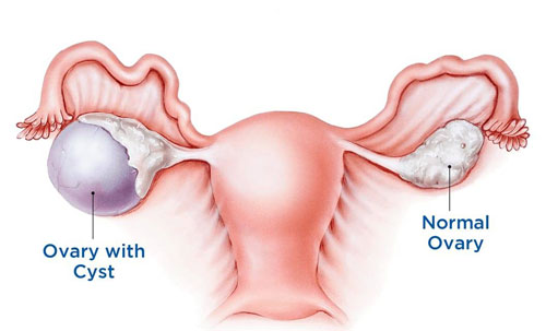doctor for ovarian cyst in Mumbai