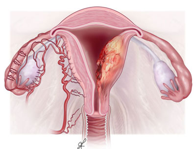 Uterine Cancer Surgery