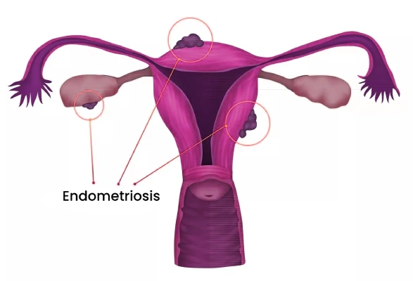 Best Doctor for Endometriosis in India Best Doctor for Endometriosis in India
