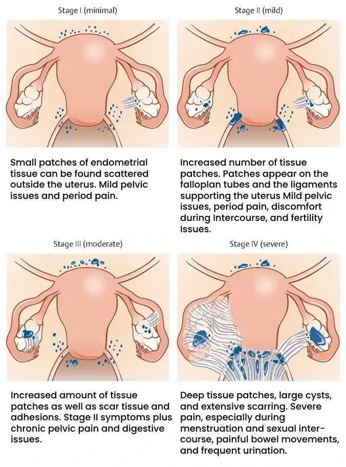 Endometriosis Progress Through Different Stages_